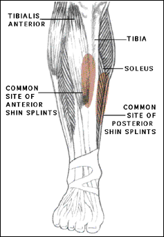 shin splint